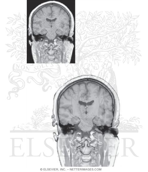 Watermarked preview of unlabeled image: Coronal Sections Through the Forebrain: Level 6 - Mammillothalamic Tract and Substantia Nigra, Rostral Hippocampus