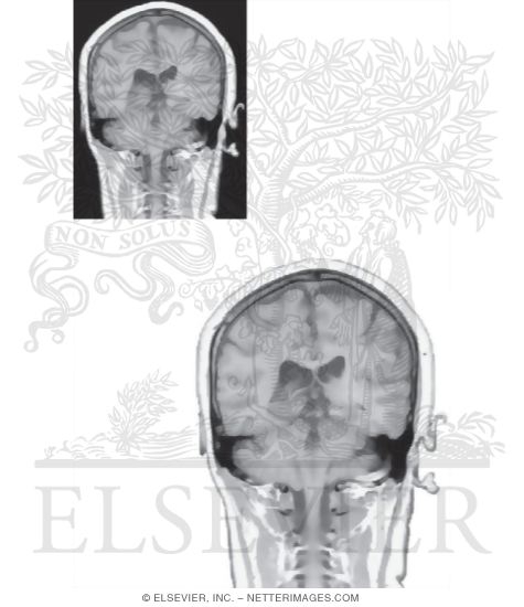 Watermarked preview of unlabeled image: Coronal Sections Through the Forebrain: Level 9 - Caudal Pulvinar and Superior Colliculus