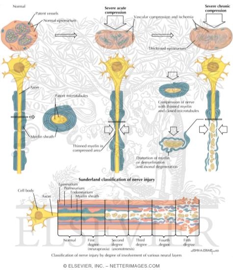 Watermarked preview of labeled image: Nerve Injury in Compression Neuropathy