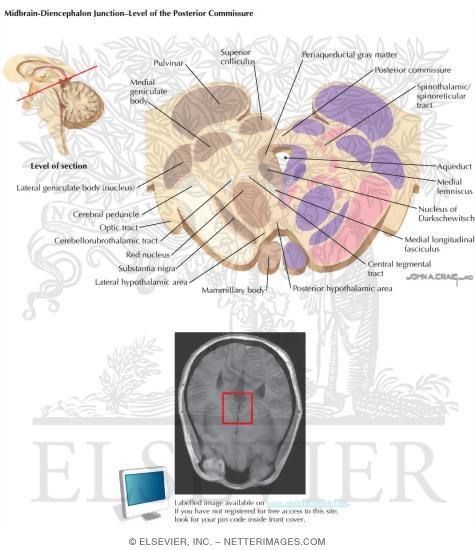 Midbrain / Diencephalon Junction - Level of the Posterior Commissure