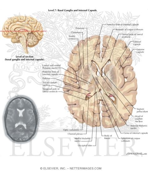 Basal Ganglia and Internal Capsule