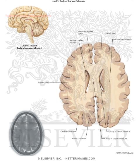 Dorsal Caudate, Splenium, and Genu of Corpus Callosum