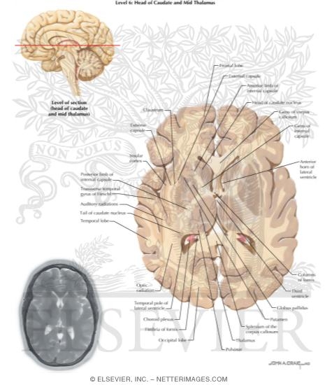 Body of Corpus Callosum