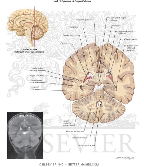 Coronal Sections Through the Forebrain: Splenium of Corpus Callosum
