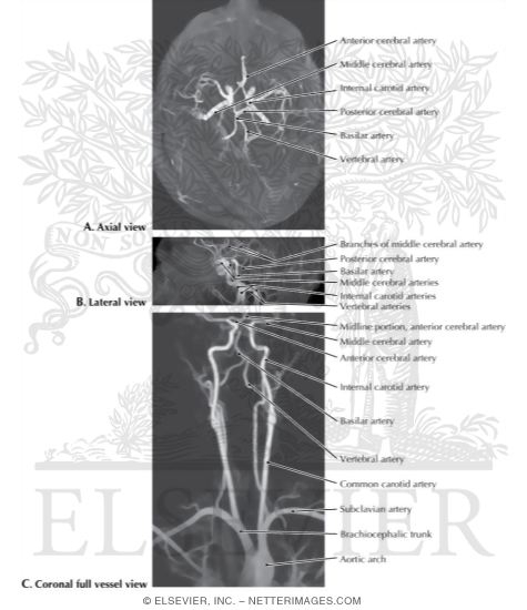 Watermarked preview of labeled image: Magnetic Resonance Angiography: Frontal and Lateral Views