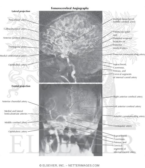 Watermarked preview of labeled image: Angiographic Anatomy of the Internal Carotid Artery