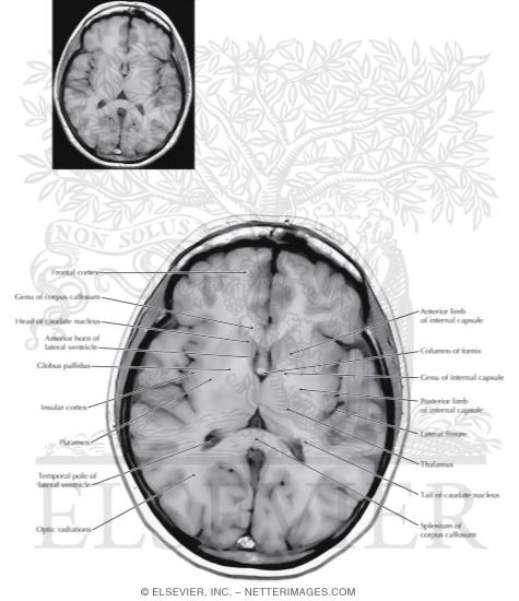 Watermarked preview of labeled image: Axial (Horizontal) Sections Through the Forebrain: Level 6 - Caudate and Mid Thalamus