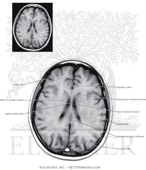 Axial (Horizontal) Sections Through the Forebrain: Level 8 - Dorsal Caudate, Splenium, and Genu of Corpus Callosum