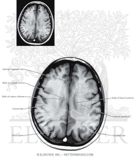 Axial (Horizontal) Sections Through the Forebrain: Level 9 - Body of Corpus Callosum