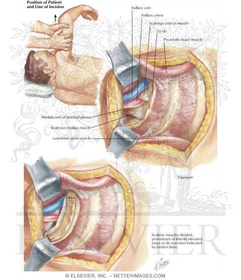 Resection of First Rib (Tranaxillary Approach)