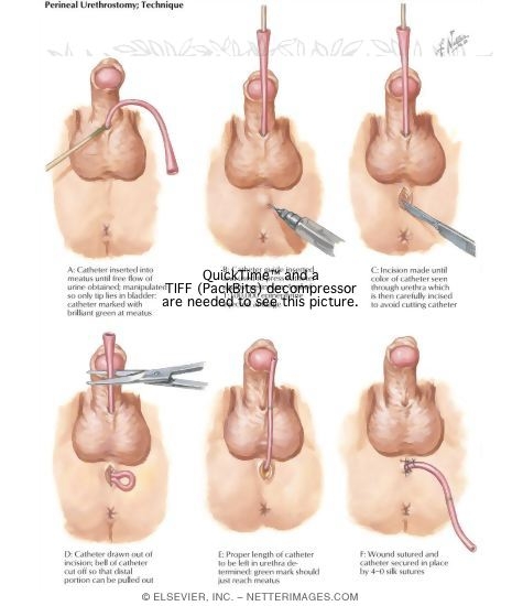 Perineal Urethrostomy How to clean the male perineal area during a bed bath (aka sponge bath) nursing skills: perineal urethrostomy