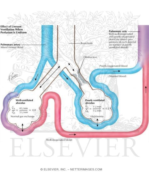 Uneven Ventilation: Uniform Perfusion