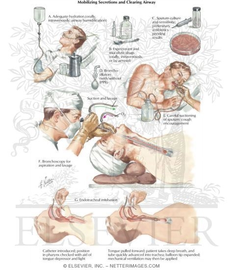 Watermarked preview of labeled image: Secretion Mobilization and Airway Patency