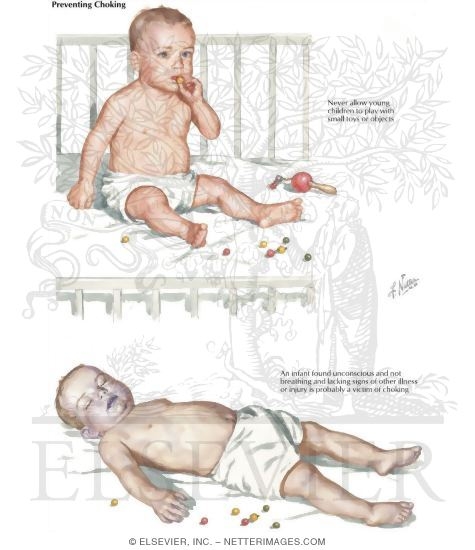 Watermarked preview of labeled image: Obstructed Airway: Infant Victim