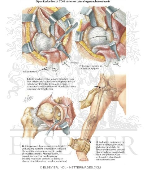 Watermarked preview of labeled image: Open Reduction: Anterior Lateral Approach