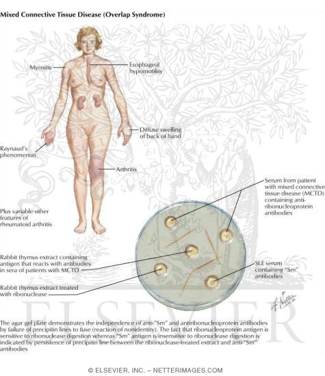 Watermarked preview of labeled image: Mixed Connective Tissue Disorders