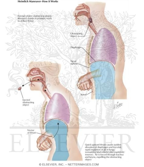 Mechanics of Heimlich Maneuver