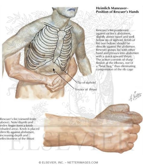 Position of Hands In Heimlich Maneuver