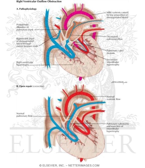 Right Ventricle Outflow Obstruction