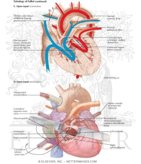 Tetralogy of Fallot