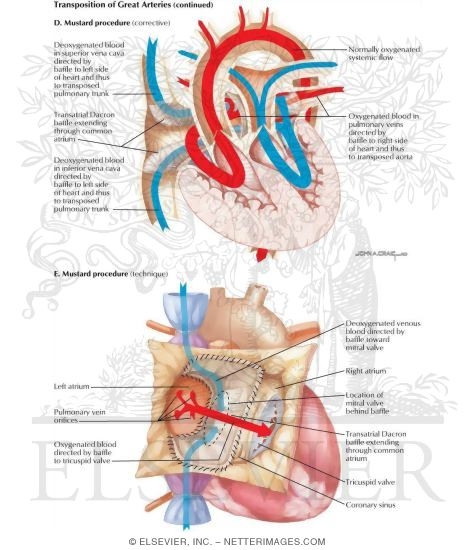 Watermarked preview of labeled image: Surgery for Congenital Heart Disease