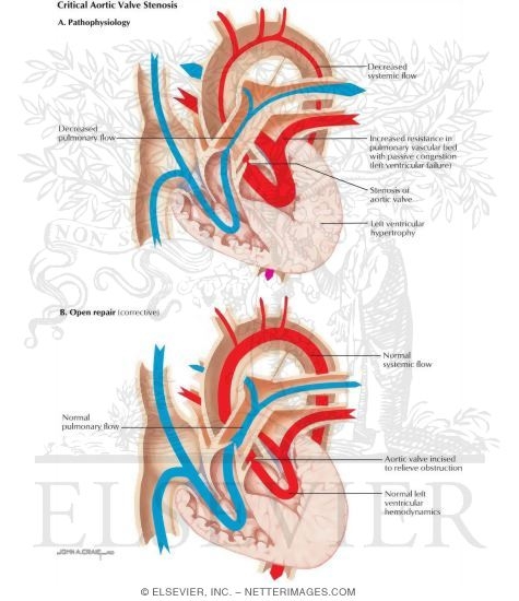 Watermarked preview of labeled image: Surgery for Congenital Heart Disease: Critical Aortic Valve Stenosis