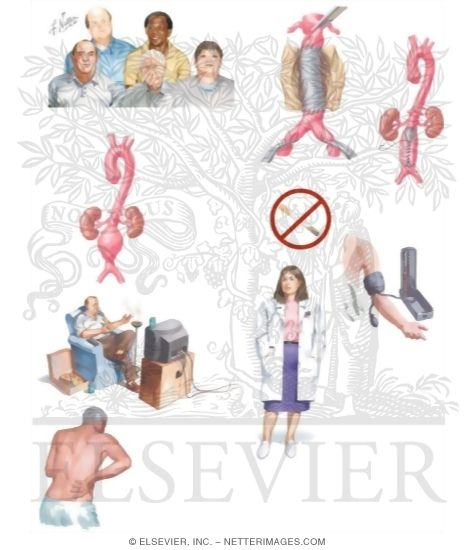 Watermarked preview of unlabeled image: Managing Your Abdominal Aortic Aneurysm