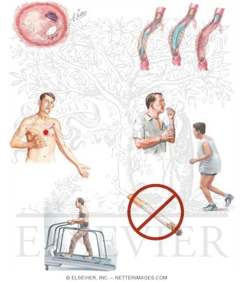 Watermarked preview of unlabeled image: Managing Your Angina