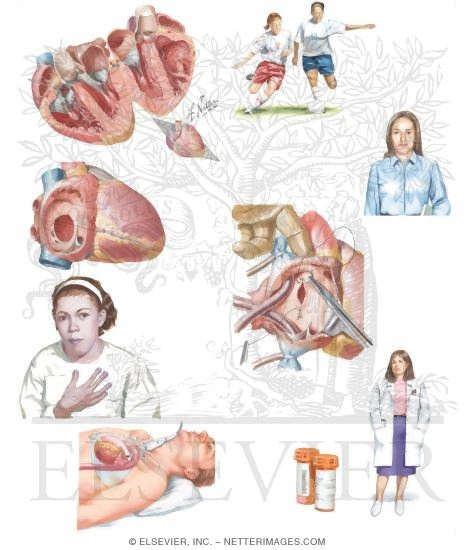 Watermarked preview of unlabeled image: Managing Your Atrial Septal Defect