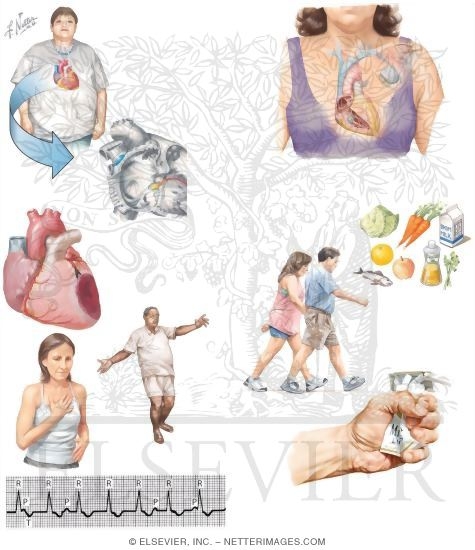 Watermarked preview of unlabeled image: Managing Your Bundle Branch Block