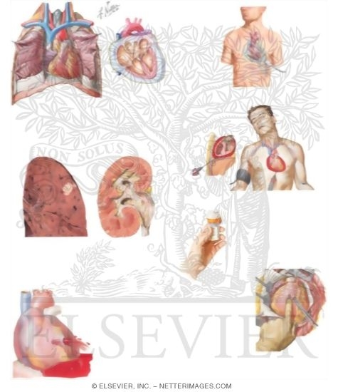 Watermarked preview of unlabeled image: Managing Your Cardiac Tamponade