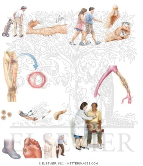 Watermarked preview of unlabeled image: Managing Your Poor Circulation