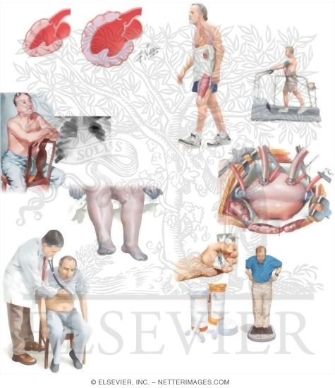 Watermarked preview of unlabeled image: Managing Your Congestive Heart Failure (CHF)