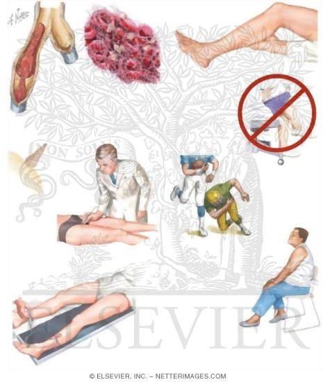 Managing Your Deep Vein Thrombosis