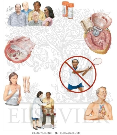 Watermarked preview of unlabeled image: Managing Your Dilated Cardiomyopathy