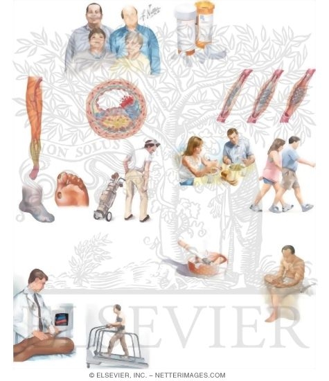 Watermarked preview of unlabeled image: Managing Your Peripheral Arterial Disease