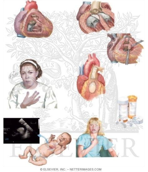 Caring for Your Child With Tetralogy of Fallot