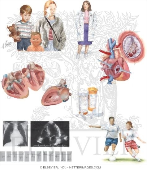 Watermarked preview of unlabeled image: Managing Your Ventricular Septal Defect