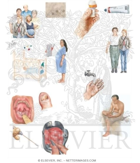 Watermarked preview of unlabeled image: Managing Your Candidiasis