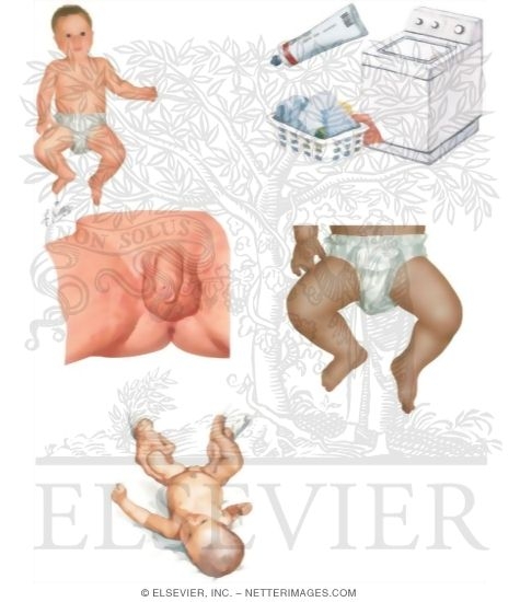 Watermarked preview of unlabeled image: Caring for Your Baby With Diaper Rash