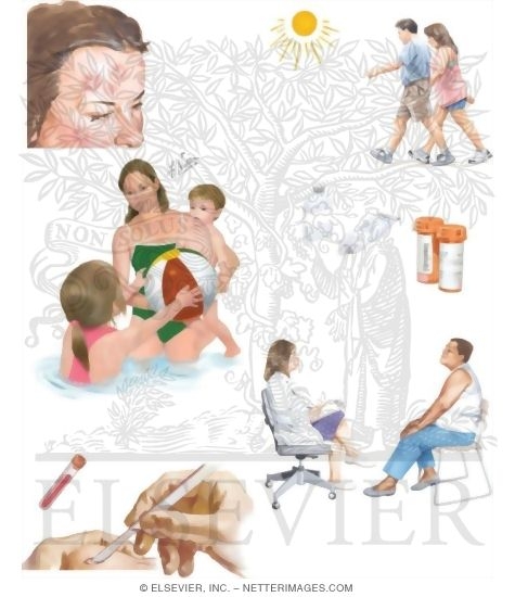Watermarked preview of unlabeled image: Managing Your Discoid Lupus Erythematosus