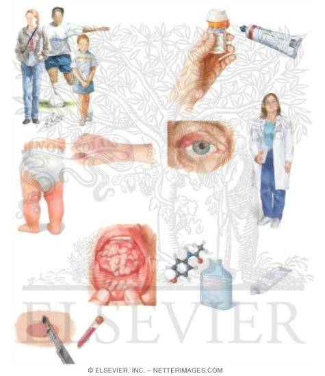 Watermarked preview of unlabeled image: Managing Your Erythema Multiforme