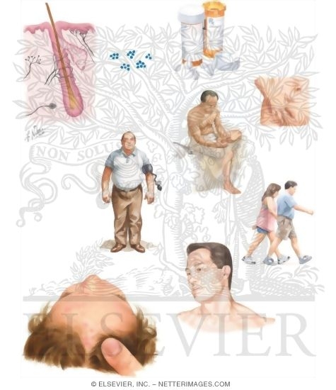 Managing Your Folliculitis