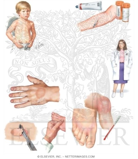 Watermarked preview of unlabeled image: Managing Your Granuloma Annulare