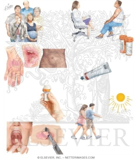 Watermarked preview of unlabeled image: Managing Your Lichen Planus