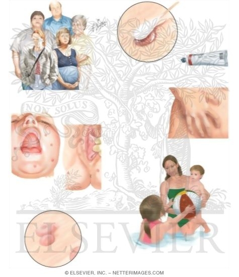 Managing Your Molluscum Contagiosum
