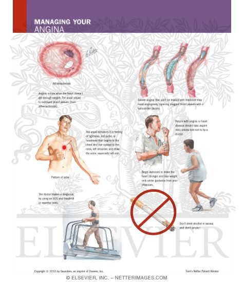 Watermarked preview of labeled image: Managing Your Angina