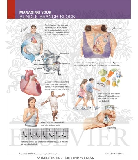 Watermarked preview of labeled image: Managing Your Bundle Branch Block