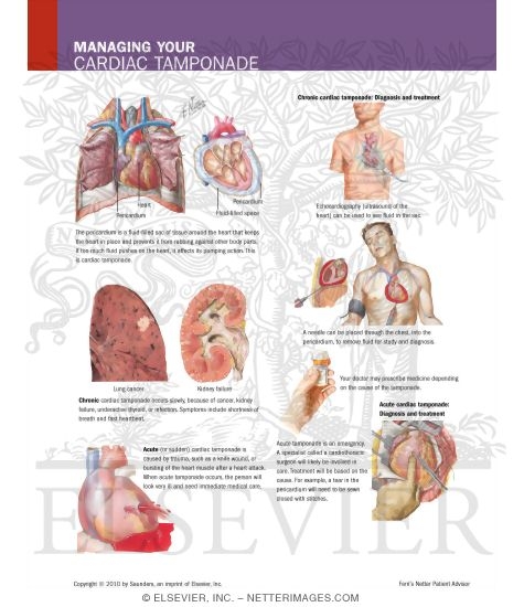 Watermarked preview of labeled image: Managing Your Cardiac Tamponade