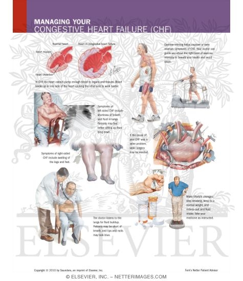 Watermarked preview of labeled image: Managing Your Congestive Heart Failure (CHF)